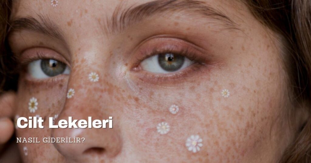 Cilt Lekeleri Nasıl Giderilir?