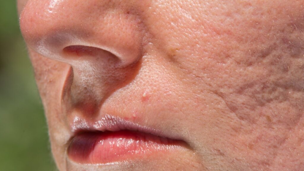 Derin Sivilce Çukurları Nasıl Geçer?